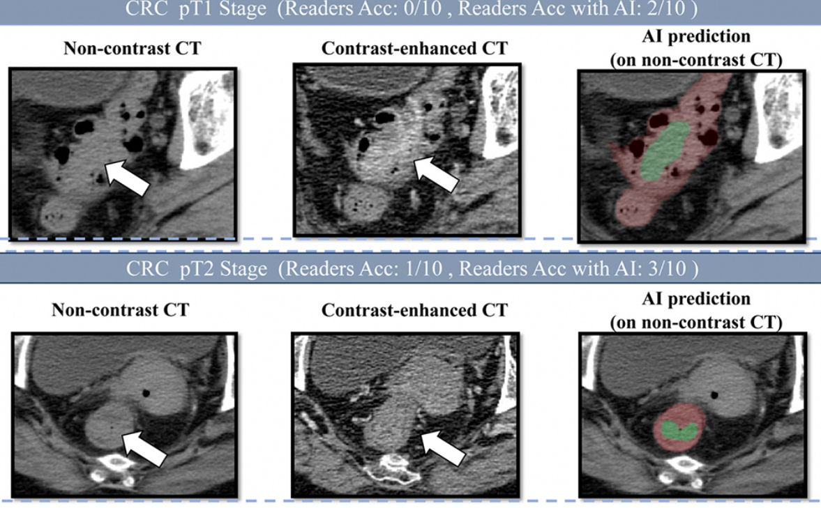 全球首次！达摩院肠癌“无感”检测模型登顶刊，靠平扫CT找出漏诊