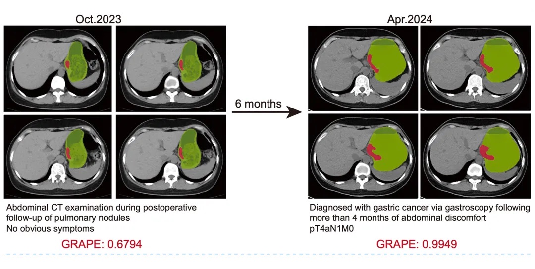 阿里达摩院推全球首个胃癌影像筛查AI模型！10万人临床支持，研究成果登《自然·医学》