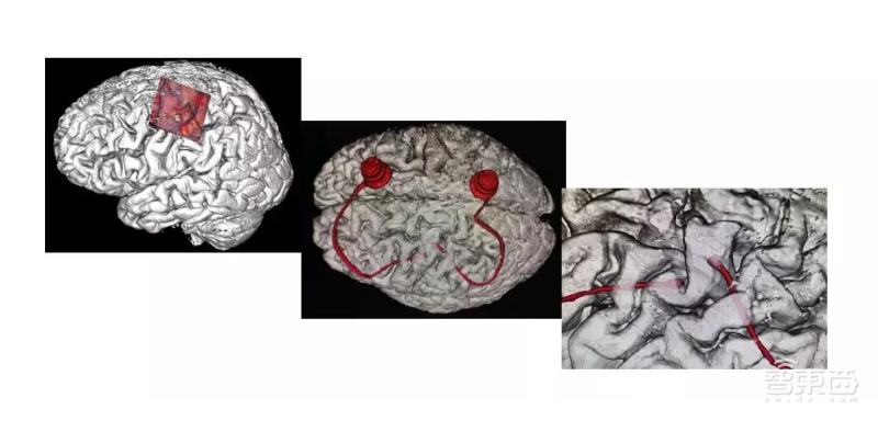 中国首例!大脑植入电极,高位截瘫病人用意念喝水