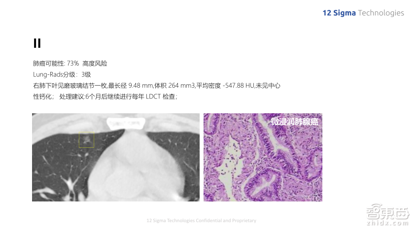 深度学习如何提升肺结节良恶性诊断准确率到90%?图玛深维首席科学家陈韵强给出了答案!