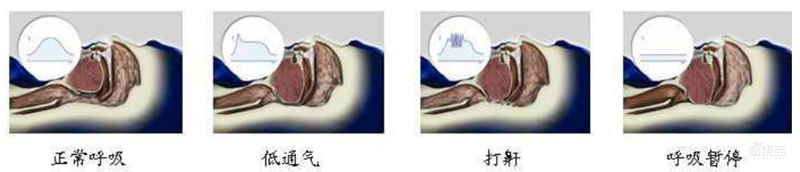 揭秘全球都在抢购的呼吸机！国内产能将近全球两倍【附下载】| 智东西内参