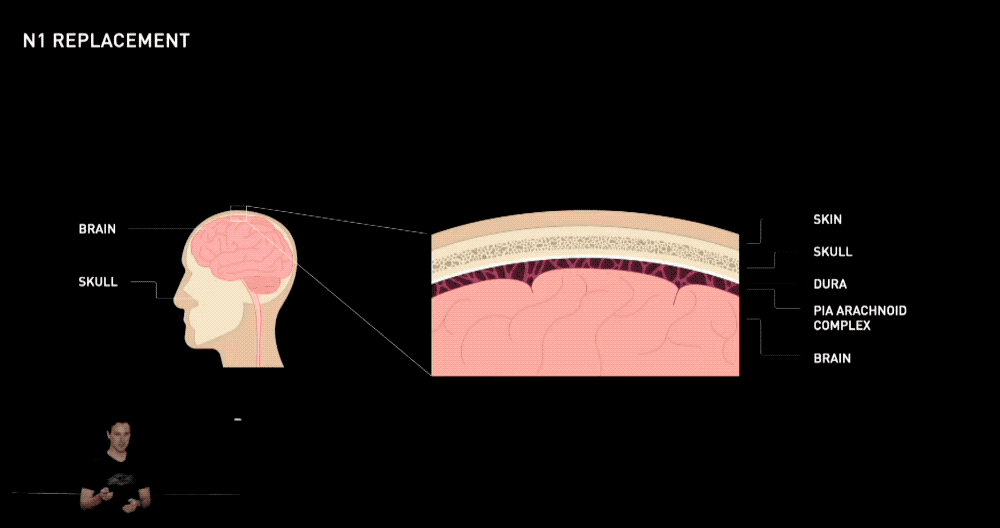 马斯克15分钟给猴脑植入芯片,演示用意念打字