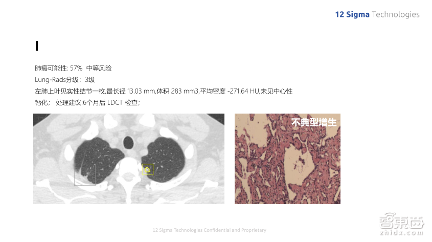 深度学习如何提升肺结节良恶性诊断准确率到90%?图玛深维首席科学家陈韵强给出了答案!
