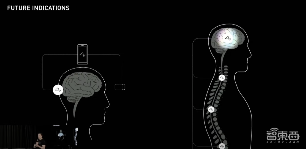 马斯克15分钟给猴脑植入芯片,演示用意念打字