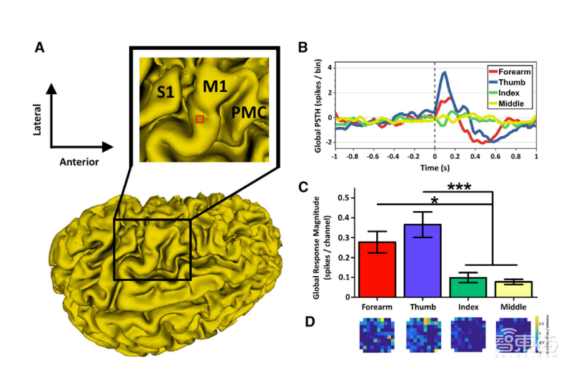 脑机接口解决脊髓损伤:患者能做20种动作,还能打游戏!